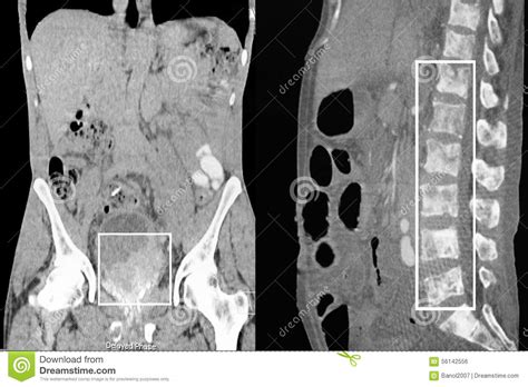 Prostate Cancer, Bone Metastases. CT scan Reconstruction ...