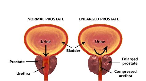 Prostate Cancer in Men | Prostate Cancer Cases, Symptoms ...