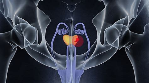 Prostate Cancer Radiation Therapy Side Effects   All About Radiation