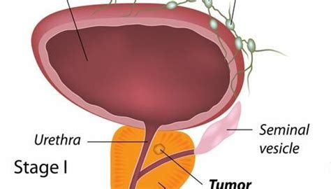 Prostate cancer risk starts in childhood