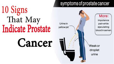 Prostate cancer signs | 10 Signs That May Indicate ...