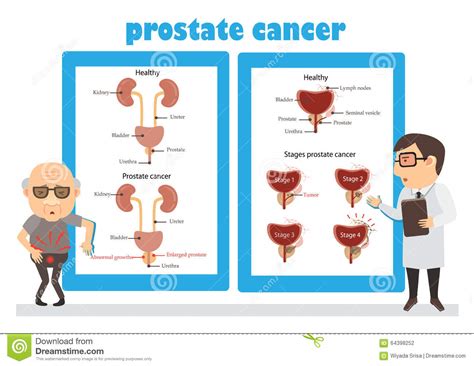 Prostate Cancer stock vector. Illustration of growth   64398252