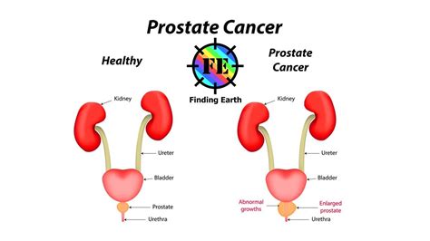 Prostate Cancer   Symptom, Causes & Diagnosis   YouTube