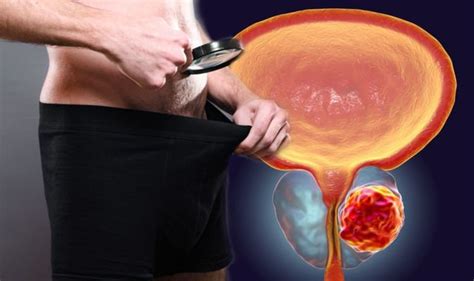Prostate cancer symptoms: If you see this in your semen do ...