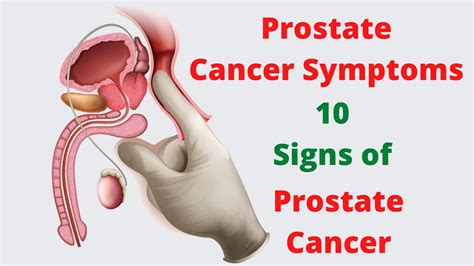 Prostate Cancer Symptoms – 10 Signs of Prostate Cancer ...
