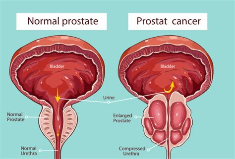 Prostate Gland Illustrations, Royalty Free Vector Graphics & Clip Art ...