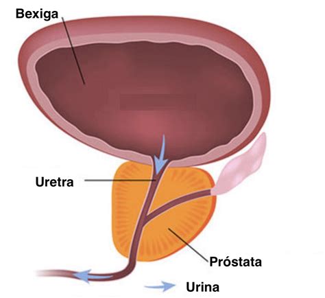 Prostatite Aguda – saiba do que se trata