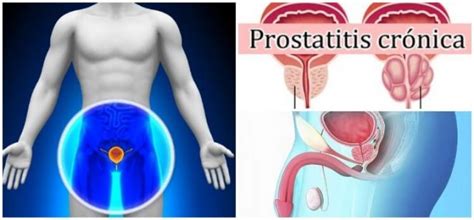 Prostatitis Crónica – Glandula Prostatica: ¿Qué Es? Causas, Síntomas y ...