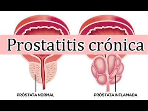 Prostatitis cronica, sintomas y Tratamiento natural   YouTube