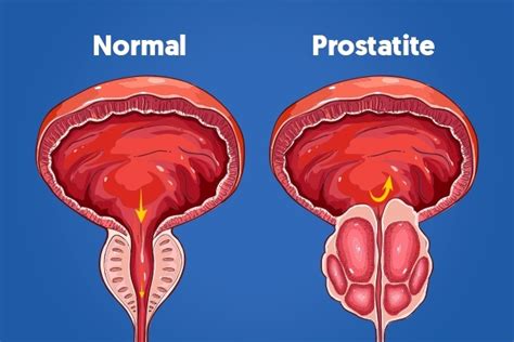 Prostatitis: qué es, síntomas, causas y tratamiento ...