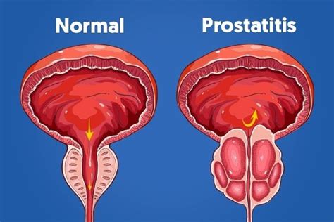 Prostatitis: Qué es, síntomas y causas más comunes | Recetas de ...