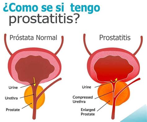 Prostatitis síntomas ⊛ ¡Prevención y Tratamiento 2020!