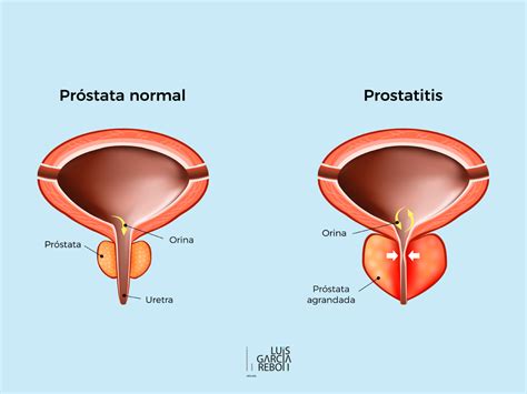 Prostatitis: tipos de infecciones prostáticas, síntomas y tratamiento