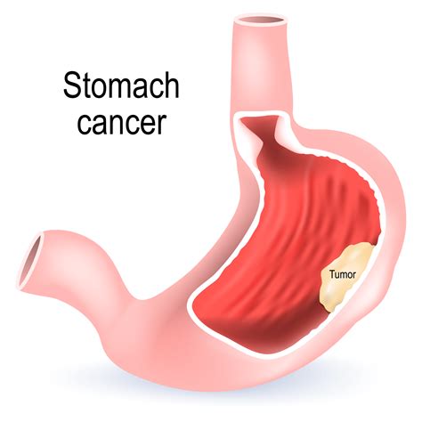 Protect Your Family from Stomach Cancer | Digestive Care ...