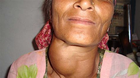 Protuberancia en el cuello: imágenes, causas, síntomas asociados y más ...