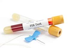 PSA: antígeno prostático específico