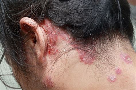 Psoriasis en la piel: ¿Cuáles son sus síntomas y cómo se puede tratar ...