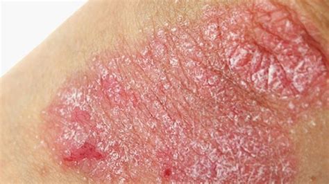Psoriasis, enfermedad de la piel que impacta emocionalmente | EL DEBATE