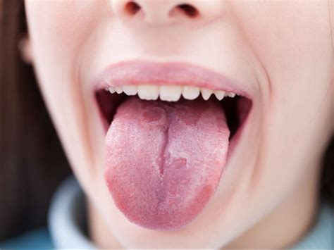 Psoriasis on the tongue: Symptoms, treatment, and prevention