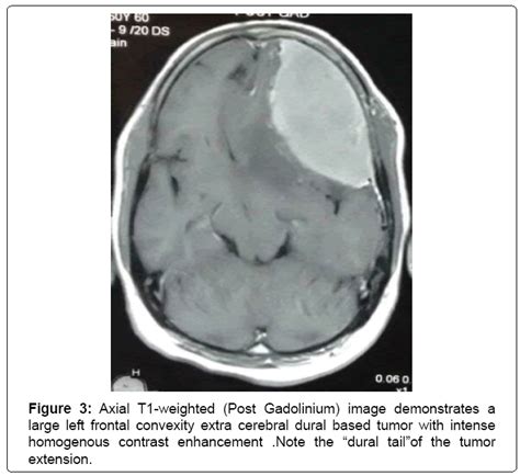 psychiatry Axial T2 weighted