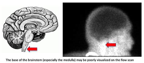 PulmCrit  Brain death, mimics, and flow scans
