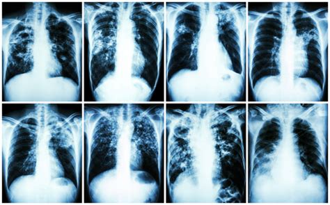 Pulmonary Fibrosis Trial Shows Ofev Slows Lung Scarring