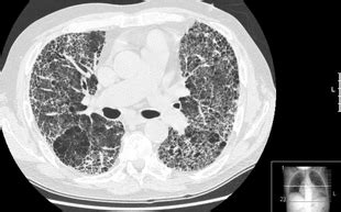 Pulmonary fibrosis   Wikipedia