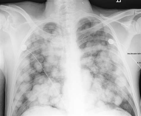 Pulmonary Metastasis | Radiographic Images | Cancer ...