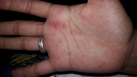 Puntitos rojos con molestias en mis manos. – dermatologo.net