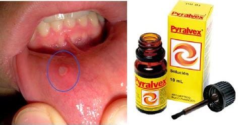 Pyralvex sirve para quitar las llagas, úlceras, de la boca.  Muguet ...