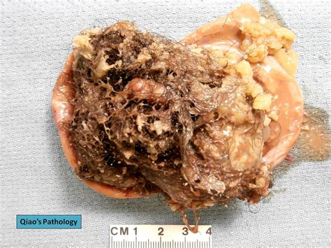 Qiao s Pathology: Ovarian Dermoid Cyst  Mature Cystic Tera… | Flickr