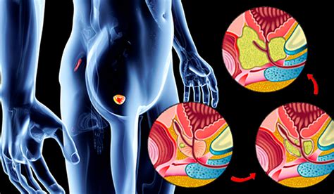 Quais os sintomas do Câncer de próstata?   Médico Urologista em SP