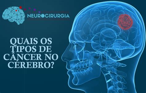 Quais os Tipos de Câncer no Cérebro? | Dr Victor Barboza ...