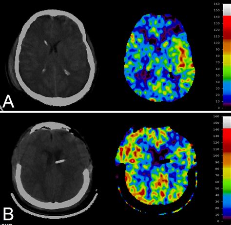 Quantitative cerebral blood flow using xenon enhanced CT ...