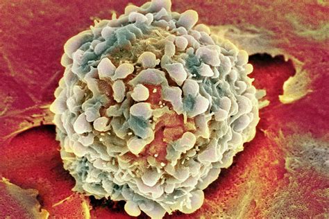 ¿Qué afecta las tasas de supervivencia del cáncer rectal?