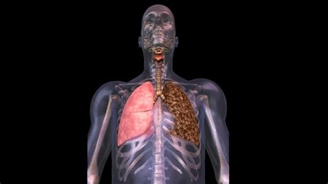 Qué es, cómo se produce y cómo se trata el enfisema pulmonar