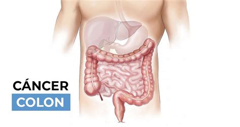 ¿Qué es el cáncer de colon? Síntomas, causas, tratamiento