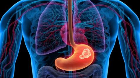 ¿Qué es el cáncer de esófago y estómago? | KienyKe