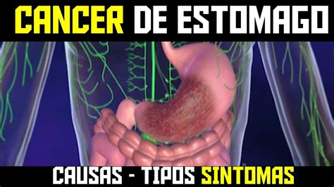 QUE ES EL CANCER DE ESTOMAGO   TIPOS SINTOMAS CAUSAS Y ...