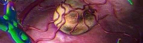 Qué es el cáncer de ovario | Mujer y ginecología | Infosalus
