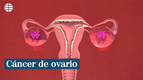 ¿Qué es el cáncer de ovario?   YouTube