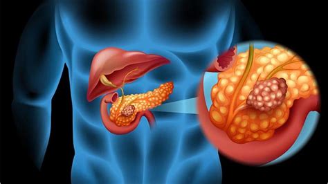 ¿Qué es el cáncer de páncreas? | Síntomas, causas y cómo ...
