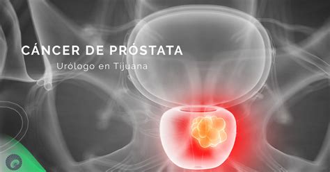 ¿Qué es el Cáncer de Próstata y Cuales son los Síntomas?
