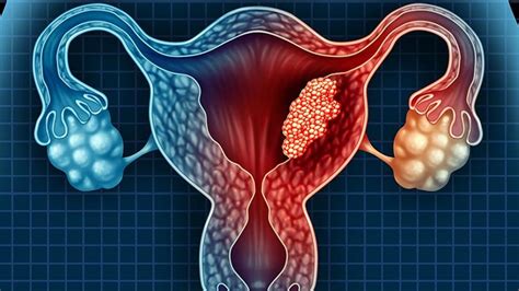 ¿Qué es el cáncer de útero? | Síntomas, causas y cómo ...