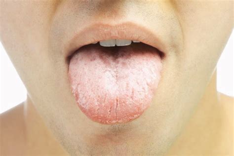 ¿Qué es el cáncer oral?   En Lucha contra el Cáncer