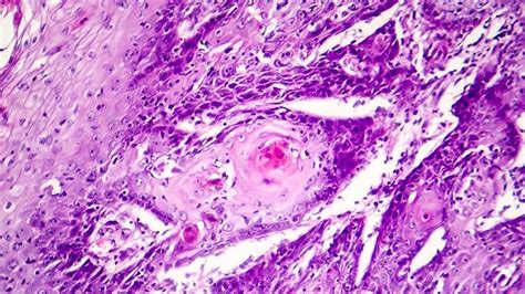 ¿Qué es el carcinoma de células escamosas o espinocelular ...