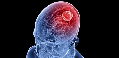 Qué es el glioblastoma: síntomas, tratamiento, esperanza ...