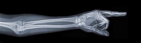 Qué es el osteosarcoma | Cáncer de huesos | Infosalus.com