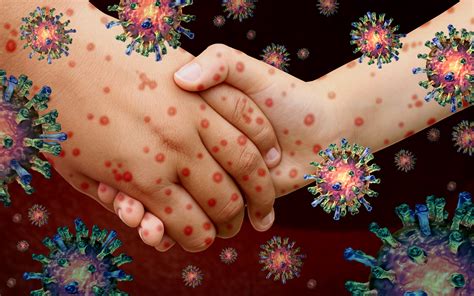 Qué es el sarampión y qué hacer para prevenirlo| Salud180