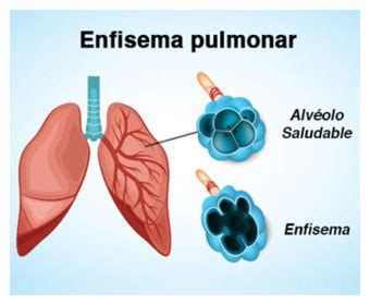 Qué es enfisema pulmonar?